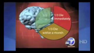 3D Hemodynamics Software for Brain Aneurysms