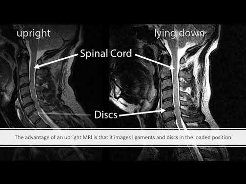 What is an Upright MRI Can It Diagnose CCJ Instability?