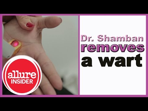 Best Ways to Remove Warts