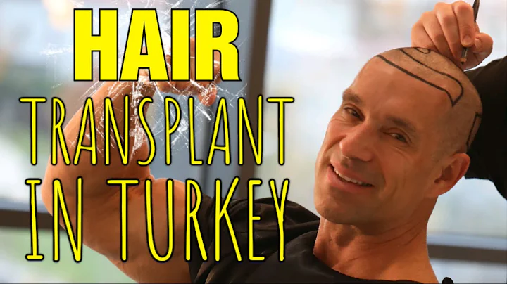 Why I Got A Hair Transplant In Turkey || Full Expe...