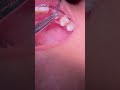 Impacted Canine Braces Treatment - 14 Months of Orthodontic Traction  - Tooth Time Family Dentistry