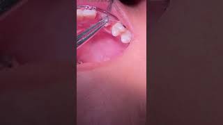 Impacted Canine Braces Treatment - 14 Months of Orthodontic Traction  - Tooth Time Family Dentistry