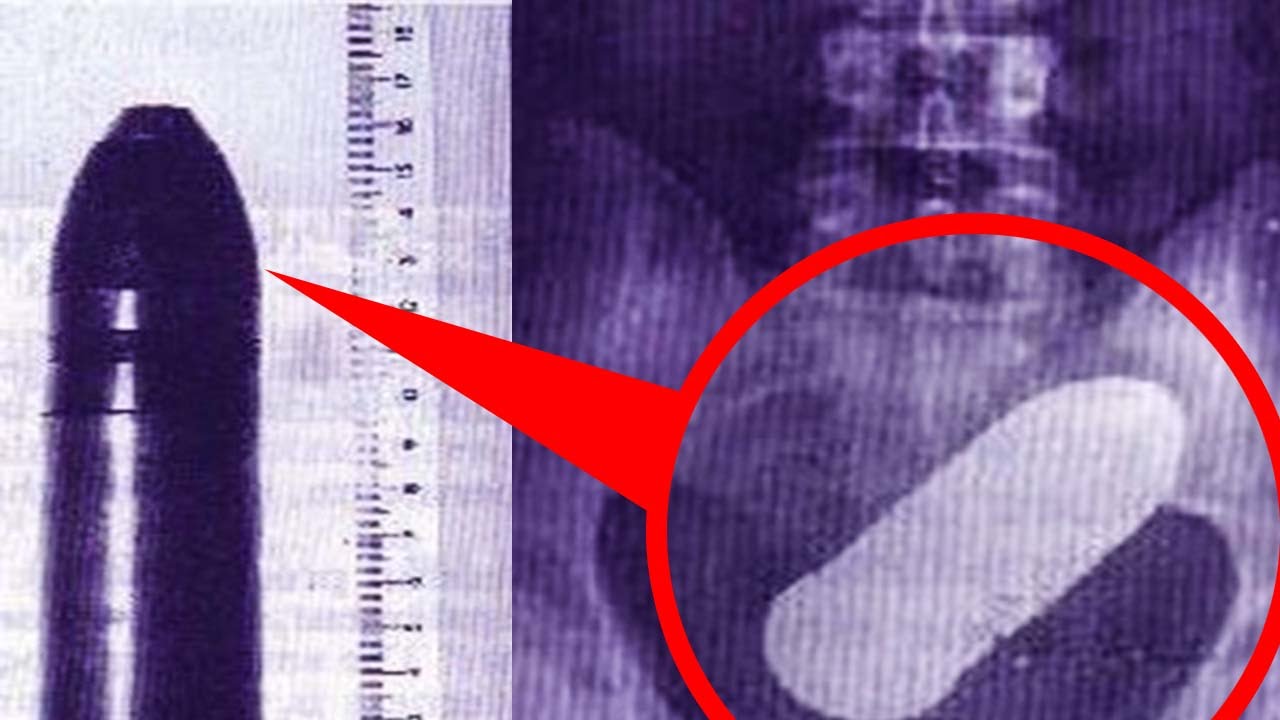 10 НЕОБЫЧНЫХ ВЕЩЕЙ, НАЙДЕННЫХ В ПРЯМОЙ КИШКЕ