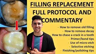 Old Fillings And Decay Near A Crack (Class II Resin Filling Replacement) | Fillings Case #1 by Dr Paul's Dental World 1,984 views 2 years ago 11 minutes, 5 seconds