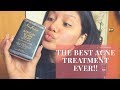 Best Acne Solution Ever : African Black Soap!!