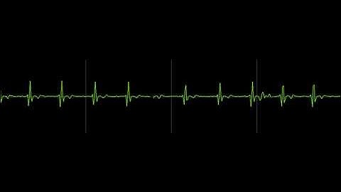 ECG Signal