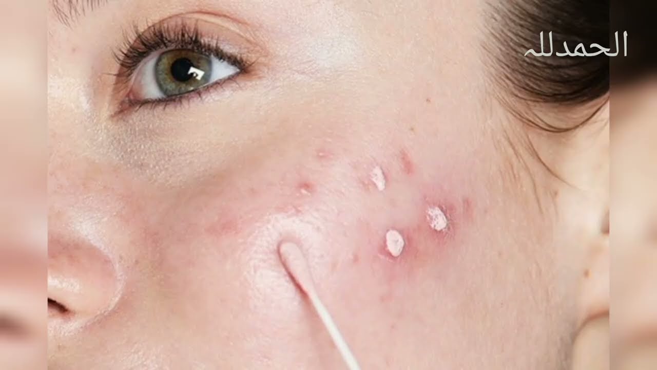 how we remove pimple acne scares remove acneremove patches of