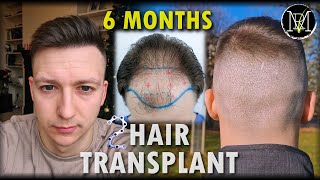 6 Months after Hair Transplant Nr.2 | 6500 Grafts | Norwood 5