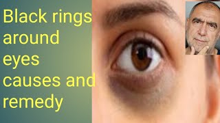 Black rings around the eyes Causes & Remedy