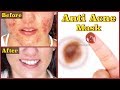 In 3 Days Get Rid of ACNE &amp; PIMPLES || Best Anti - Acne Mask