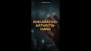 SWAN Neck Deformity Causes & Grip Loss | Rheumatoid Arthritis Hand