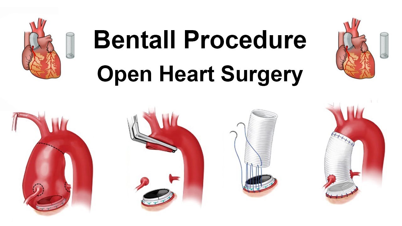 case study bentall procedure