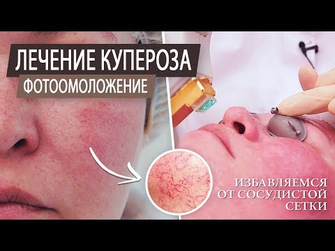 Видео: Помогает ли импульсный лазер на красителе при розацеа?