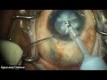 Live surgery by dr mohan rajan uttara eyecon 2022 from chennai