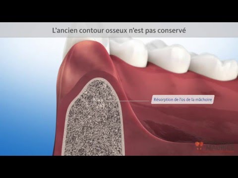 Vidéo: Qu'est-ce que l'alvéoloplastie sans extractions ?