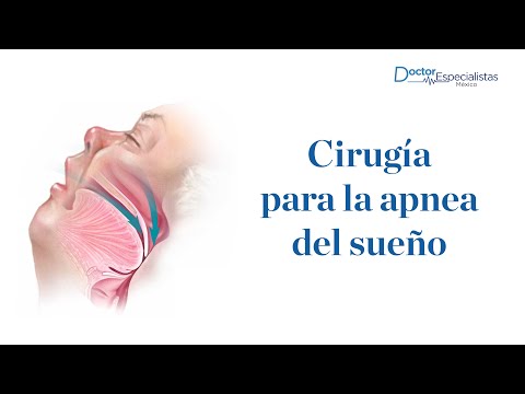Vídeo: Cirugía Para La Apnea Del Sueño: Procedimientos, Tasa De éxito Y Riesgos