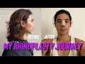 I HAD A NOSE JOB (Rhinoplasty) at The Icon Clinic Part 1 | Jeff Ong