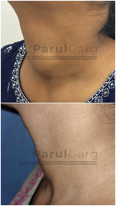🌟 See the Amazing #Results of #ThyroidNoduleAblation in Just Under 3 Months! 🌟