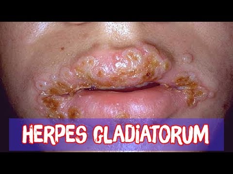 Video: Herpes Gladiatorum (MAT): Príčiny A Liečba