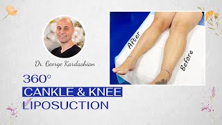 I Finally Have Ankles! | 360° Cankle & Knee Liposuction for Lipedema by Dr. George Kardashian