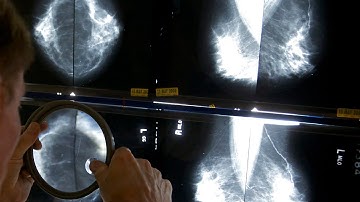 AI just as good at detecting breast cancer as humans: study