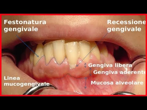 Video: Come Trattare la Candidosi Orale: 11 Passaggi (con Immagini)