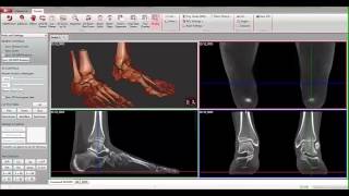 Flat Foot Pedcat Scan