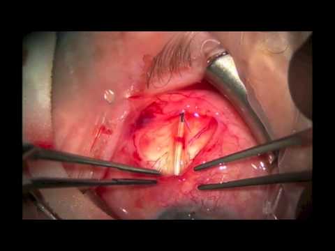 Baerveldt Glaucoma Implant