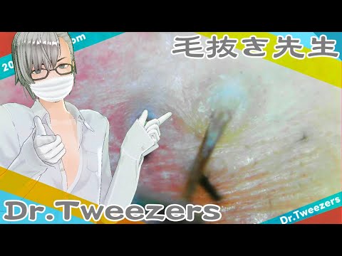 210 [200x Zoom] Why do people see hair pulling Dr. tweezers 毛抜き先生の角栓や毛根