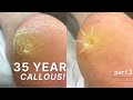 35 YEAR OLD CALLOUS 😱 Removing Callouses & Super Deep Corns PART 2!