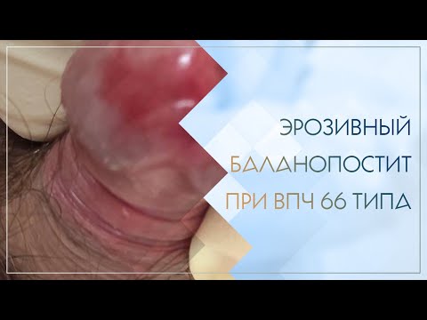 😲 Эрозивный баланопостит при ВПЧ 66 типа. Клинический случай №68
