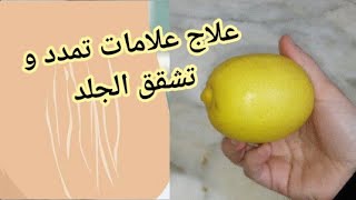 علاج علامات تمدد الجلد البيضاء و الحمراء  علاج تشققات الجلد