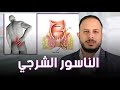 الناسور الشرجي علاج مختلف وفعال بدون جراحة