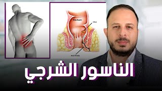 الناسور الشرجي علاج مختلف وفعال بدون جراحة