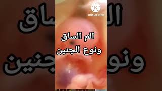 هل تعلم ما هي العلاقة بين الم الساق (الورك)ونوع الجنين