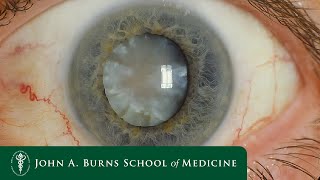 Cataracts and the Aging Eye - Mini-talk - Dr. Brandon Lee