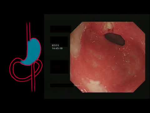 REFRACTORY COELIAC DISEASE, ULCERATIVE JEJUNITIS / DUODENITIS & LYMPHOCYTIC GASTRITIS