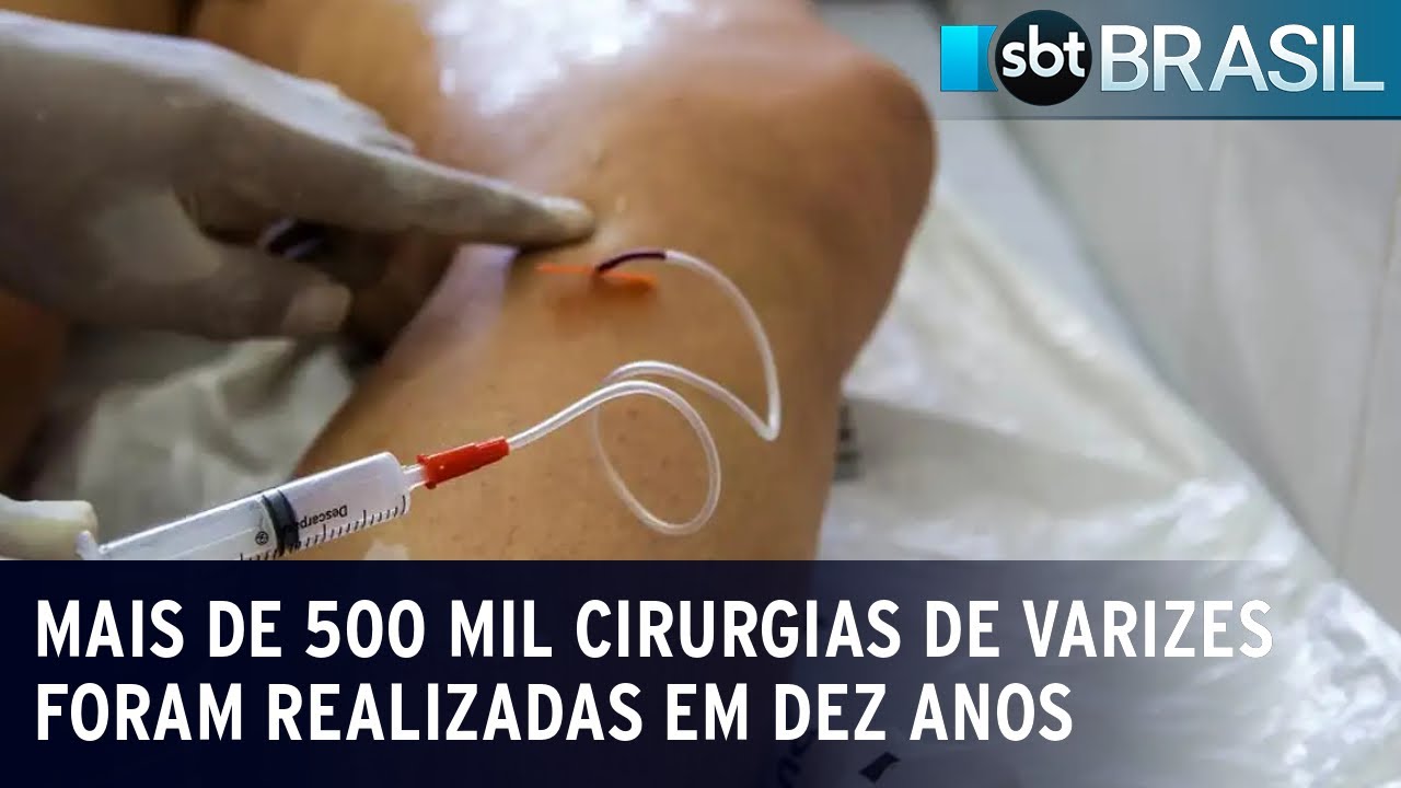 Mais de 500 mil cirurgias de varizes foram realizadas em dez anos | SBT Brasil (13/01/24)