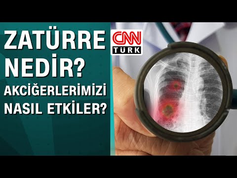 Zatürre nedir? Akciğerlerimizi nasıl etkiler?