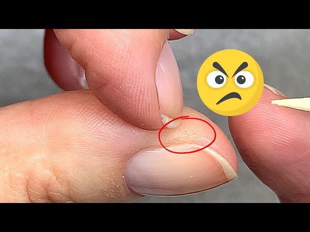 12 Reasons Why Your Fingertips May Be Peeling – SkinKraft