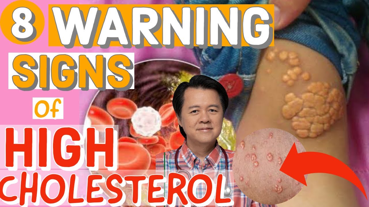 8 Warning Signs of High Cholesterol - By Doc Willie Ong #1098