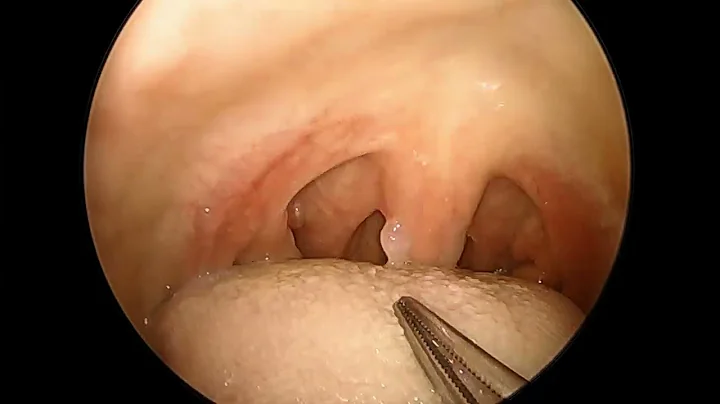 Removal of uvula papilloma (in office)