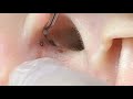 THE MOST VIEW...FOUR BIG BLACKHEADS ON THE EAR...SATISFYING VIDEO #2 #relaxing #blackheads