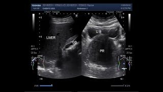 Ultrasound Video showing a grossly enlarged Prostate ( BPH ).