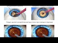 Лечение катаракты. Операция и удаление катаракты. Факоэмульсификация с имплантацией ИОЛ