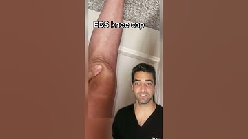 Knee cap hypermobility, EDS