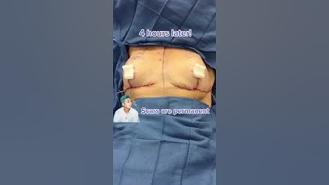 Droopiest Breasts get Lifted #shorts