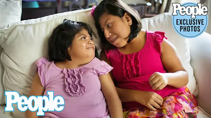Conjoined Twins Who Made Headlines for 2002 Separa...