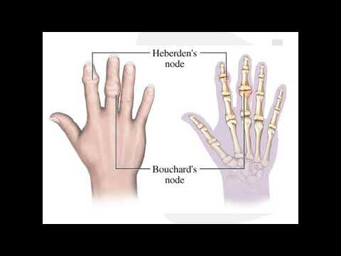 ตำราความเจ็บปวด ข้อเสื่อม (osteoarthritis)