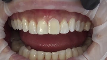 Rebel.dental mock-up tutorial - Gingival zenith position - crown lengthening